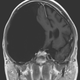 Leggett’s arachnoid cyst is thought to be one of the largest ever recorded by doctors.